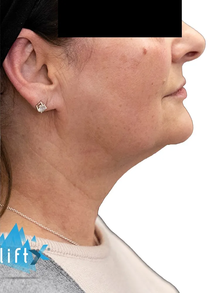 After Endolift: jawline and neck