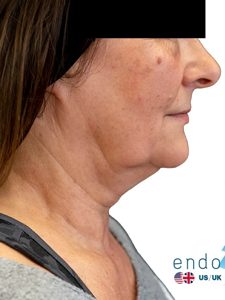 Before Endolift: jawline and neck