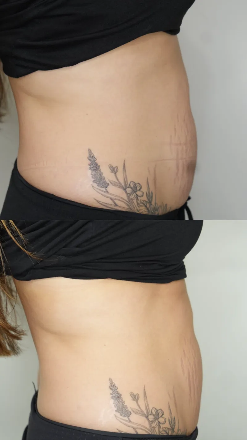 Abdominal skin tightening before (top) and after (bottom): a smoother, flatter stomach profile