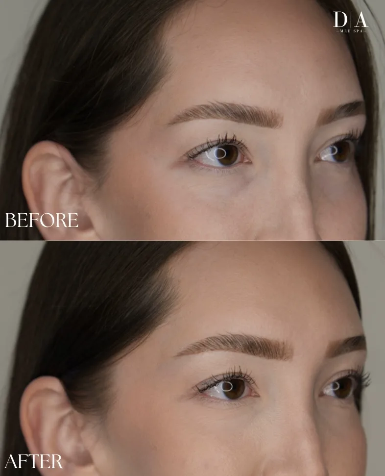 Under-eye filler before and after: hollows under the eyes softened for a more rested look